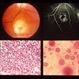 Cryptococcus Cryptococcus